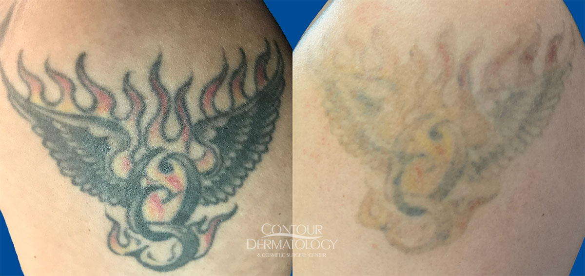 Tattoo Removal in Thrissur - topplasticsurgery